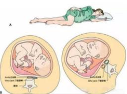 權(quán)威外科解讀 孕婦更應(yīng)注意下肢深靜脈血栓