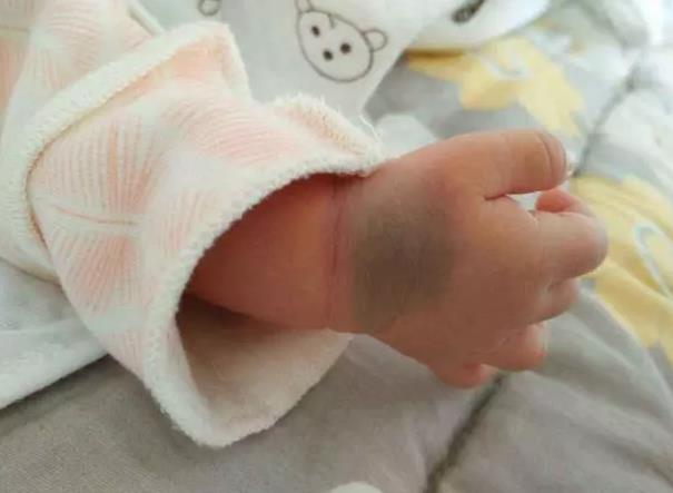 如何預防孕期產(chǎn)生胎記影響寶寶容貌