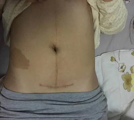 剖腹產(chǎn)的后遺癥要明白——傷口多久才能愈合