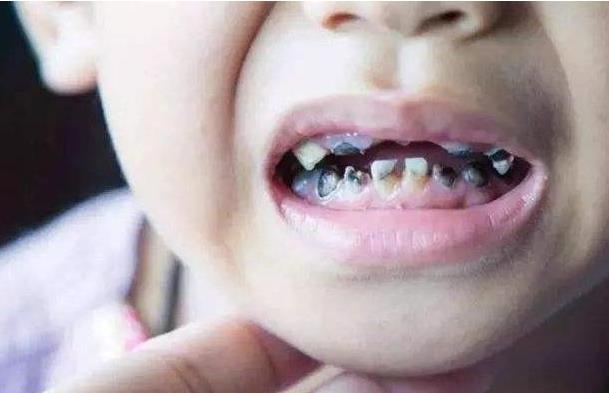 孩子滿口"黑牙"不一定是因為是糖果！