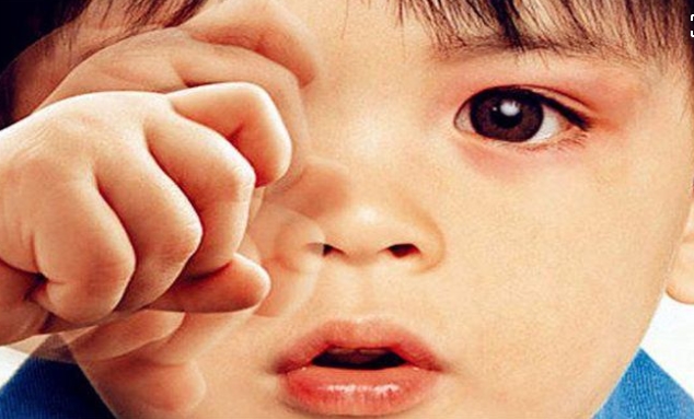 小孩頻繁揉眼，小心兒童過敏性結(jié)膜炎來襲