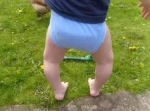 寶寶走路O型腿很擔心 一定要了解腿型發(fā)育