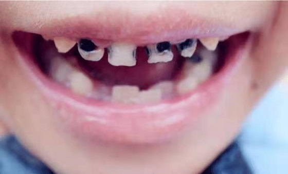 孩子長(zhǎng)了“小黑牙”，不僅與糖果有關(guān)，還有這些壞習(xí)慣