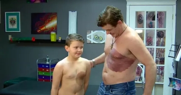 加拿大爸爸忍痛紋胎記，助力兒子擺脫自卑