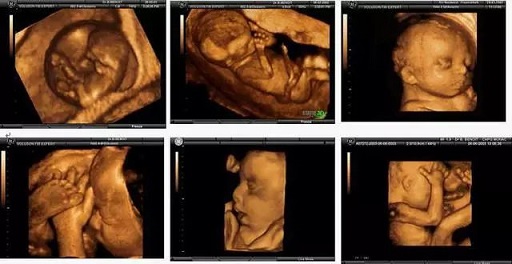 孕檢必須要做四維嗎？結(jié)果可能讓你想不到