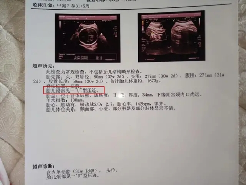 孕媽要注意了，你的這些習(xí)慣可能讓胎兒臍帶繞頸