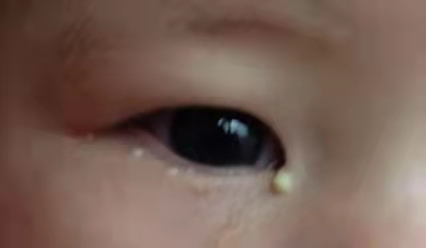 寶寶有眼屎了怎么辦？家長們不要大意了！