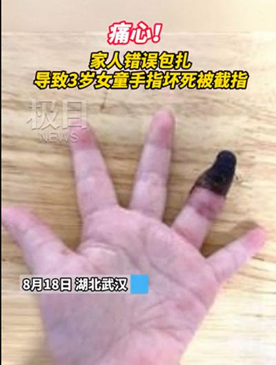 創(chuàng)可貼可別亂用，三歲女童因錯誤包扎手指壞死
