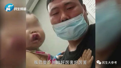 一歲寶寶嘴唇上翻，兩天后被確診白血病