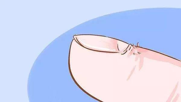 孩子手上長(zhǎng)倒刺是缺鋅？真正的癥狀在這里，家長(zhǎng)別大意