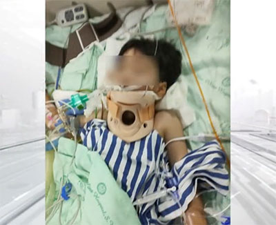 四川十歲男孩開卡丁車追尾面臨高位截癱