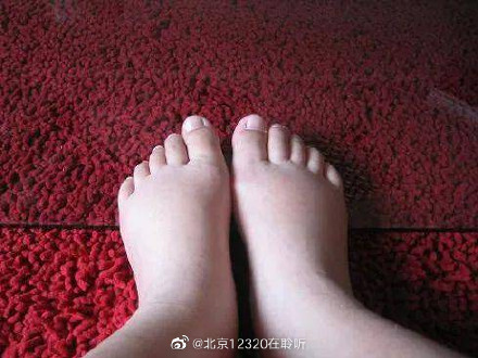 孕期生理性水腫需要治療嗎？