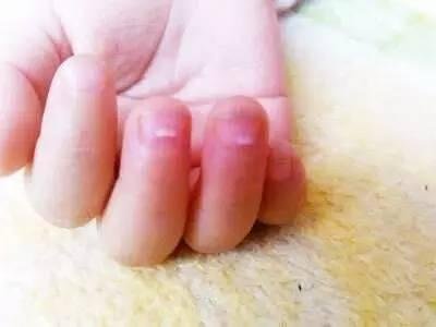 孩子上手的倒刺可能是身體在“求救”，家長千萬要注意