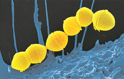 “食人菌”真的會“吃人”？