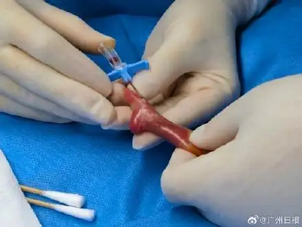 出生時腳掌都沒有成人小拇指大！廣東最輕超早產(chǎn)兒出院