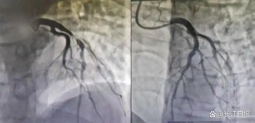 小伙熬夜+酗酒引發(fā)心梗，不良生活習(xí)慣正在摧毀年輕人的心臟